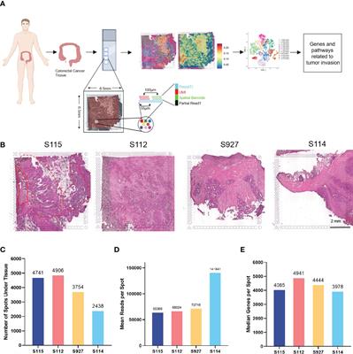 Spatially resolved transcriptomics revealed local invasion-related genes in colorectal cancer